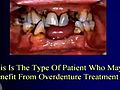 Lecture 11 - Partial denture attachments,  Dental Prosthodontics