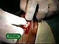 Nasolabial Cyst Excision