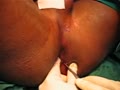 Lateral internal sphincterotomy Closed