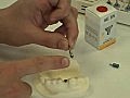 Dental Implant Procedure Training Video