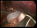 Laparoscopic Gastric Band