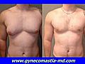 Dr Blau / Gynecomastia Severe Male Breast Reduction