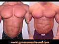 Gynecomastia Surgery ; Dr,  Blau ; Body Builders ; Male Breast Reduction,gynecomastia surgery