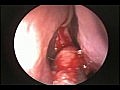 Endoscopic Removal of a Maxillary Sinus Cholestero