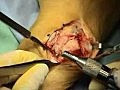 Ulnar Head Excision