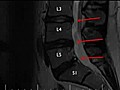 disc herniation and how to heal it naturally and without back surgery