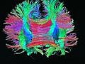 Superfast MRI technology helps map human brain