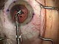 Modern Cataract Surgery: Alcon ReSTOR IOL with LRI