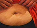 Scar-free surgery for obesity