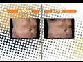 Liposuction Alternative in Portland,  Oregon