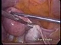 lap myomectomy