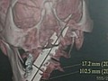 Doctors Find Blade in Man’s Skull