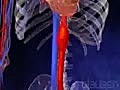 Aortic Aneurysm 3D Animation