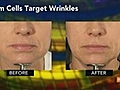 Fibrocell Stem-Cell Wrinkle Smoother Wins FDA Clearance