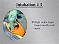 How To Perform Endotracheal Intubation