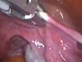 Laparoscopy Hysterectomy TLH LAVH Video (Lap Uteru