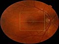 Fundus Exam