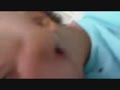 Huge Splinter Goes Through Guys Head And Pops Out His Face