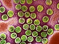 HPV-Related Throat Cancer on the Rise