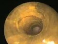 Normal Ear Tympanic Membrane