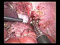 Laparoscopic Liver Resection of Right Lobe