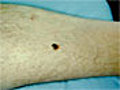 Skin Cancer