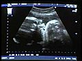 J&#039;accueille un embryon