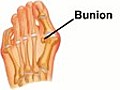 Bunions - Podiatrist in Myrtle Beach,  Conway, Little River and Surfside Beach