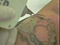 Remoção de Tatuagem - tattoo Removal