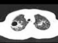 Chest x-ray --Tuberculosis