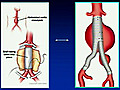 Abdominal Aortic Aneurysm Disease: Silent Killer