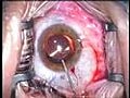 ICL Implantation Small Pupila Case