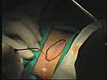 Laser Surgery Pilonidal Cyst Removal