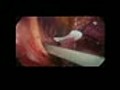 Laparoscopic Resection of Splenic Artery Aneurysm