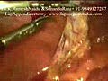 Laparoscopy Appendicectomy Video 1 ( Keyhole / Lap...