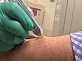 New Tool to Diagnose Melanoma