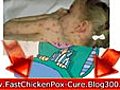 cure chicken pox - chickenpox remedy - chicken pox cures - remedy chicken pox