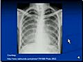 Chest X-Ray Interpretation - Miliary Tuberculosis