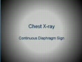 chest x-ray --Pneumomediastinum