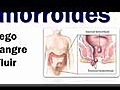 Como Curar las Hemorroides - Hemorroides Tratamiento - Hemorroides Externas - Hemorroides Internas