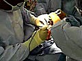 Transmetatarsal Amputation für Gangrän