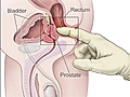 Prostat büyümesinin belirtileri nelerdir?