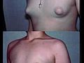 Dr. Blau / Gynecomastia Adolescent / Male Breast Reduction Teens