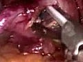 Keyhole Laparoscopy