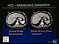 UCSF 2010 Liver Transplant: Hepatocellular Carcinoma and Iron Overload