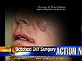 VIDEO: The dangers of DIY cosmetic surgery