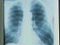 Gene Fix Can Repair Damaged Lungs