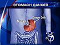 Stomach cancer and how it is treated