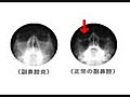 鼻レントゲン検査の一般的結果について