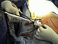 Composix EX Laparoscopic Repair of Ventral Defect